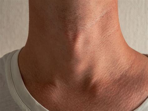 A Comprehensive Overview of Adam's Apple Reduction: Achieving a Harmonious Neck Profile