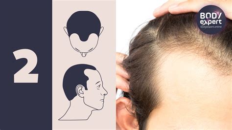 Norwood-Hamilton scale: the 7 stages of male pattern baldness