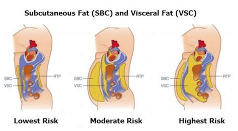 Health Risks of Visceral Fat