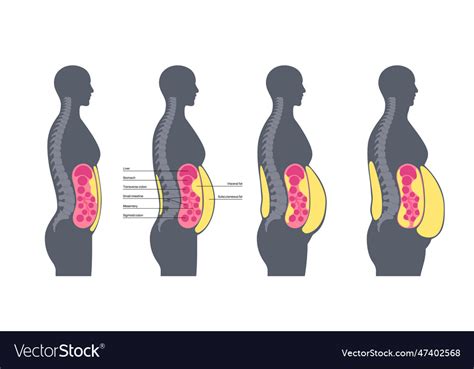 Types Of Body Fat Visceral Subcutaneous at Frances Chavez blog