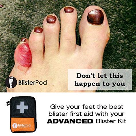 Hiking Advanced Blister Kit – Gear Up for Your Next Adventure ...