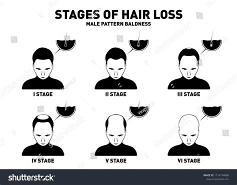 Hair Loss Stages Types Male Hair Stock Vector (Royalty Free) 1116194888