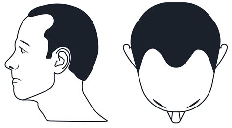 Norwood Scale - Hair Transplant Mentor