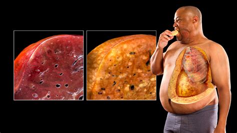 Unhealthy Liver Images 24 Best Liver Damage From Alcohol images ...