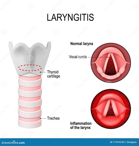 Laryngitis. Normal and Inflamed Larynx Stock Vector - Illustration of cartilage, health: 117410143