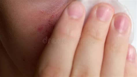 Teenage Boy with Acne Problem Clean Face Skin with Cleanser Close-up Stock Video - Video of ...
