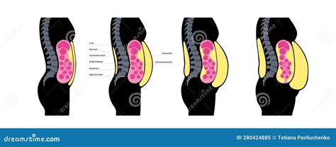 Visceral fat diagram stock illustration. Illustration of weight - 280424885