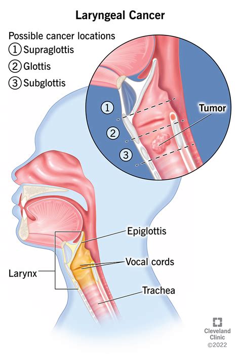 Which specific cartilage in the larynx is typically more pronounced in men, often forming the ‘Adam’s apple’?