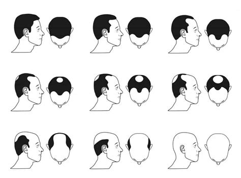 What are the typical stages of male pattern baldness?
