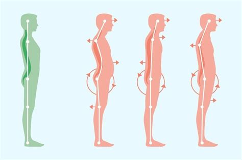 Standing Posture - Ormond Physiotherapy