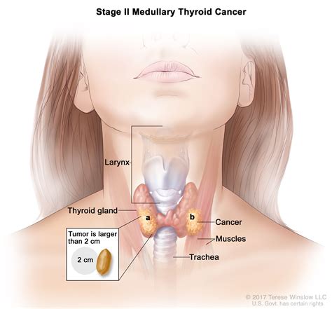 Thyroid Cancer Treatment (PDQ®)–Patient Version - NCI